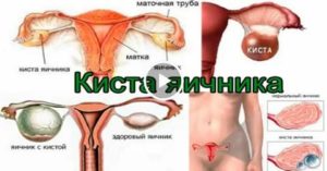 Может ли быть киста в яичнике если ты еще девственница