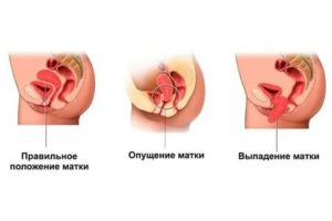 Диагностика выпадения шейки матки