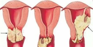 Рак матки первые признаки и симптомы в пожилом возрасте