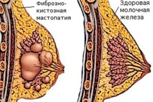 Можно ли ставить мирену при фиброзно кистозной мастопатии