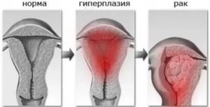 Что такое железисто кистозная гипертрофия шейки матки