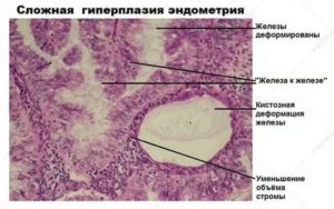 Эндометриоз железистая гиперплазия эндометрия фиброзная