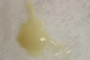 Жидкие выделения при молочнице на 35 неделе беременности