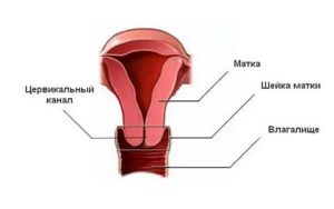 Цервикальный канал сомкнут это бесплодие