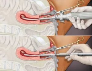 Какие должны быть месячные после диагностического выскабливания