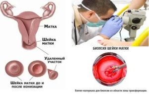 Могут ли начаться месячные раньше после конизации шейки матки
