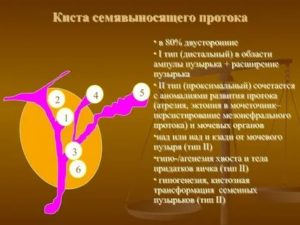 Что такое киста семявыносящего протока