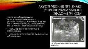 Иссечение ретроцервикального эндометриоза что это такое