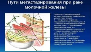 Лимфодиссекция при раке молочной железы это