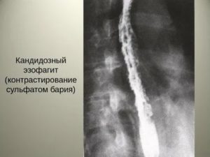 Кандидоз пищевода при спиде