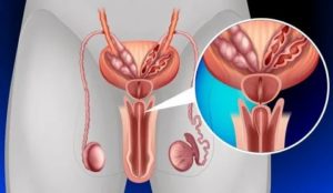 Грибковые заболевания предстательной железы