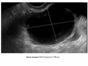 Когда делать узи кисты яичника если нет месячных