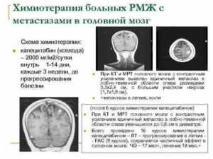 Метастазы в головном мозге при раке молочной железы прогноз