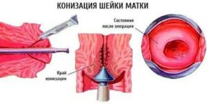 Какие препараты принимать после конизации шейки матки