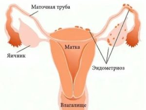 Коричневые выделения эндометриоз тела матки