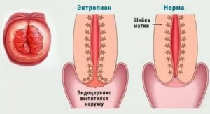 Рубцовая деформация шейки матки и рак