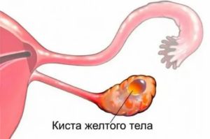 Что такое функциональная киста яичника и как ее вылечить