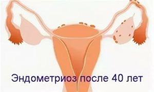 Народные средства из зож лечение эндометриоза