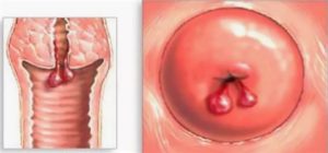 При беременности опухоль влагалища