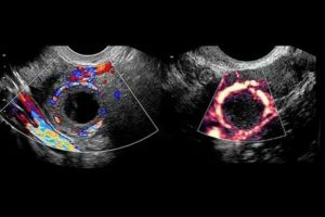 Текоматоз яичников на узи