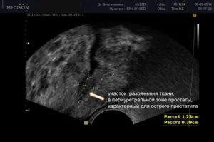 Абдоминальное узи предстательной железы что это такое