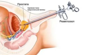 Интрауретральное лечение простатита