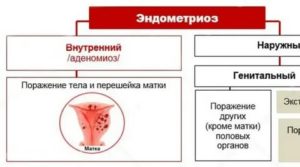 Эхографические признаки внутреннего эндометриоза что это такое