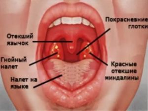 Кандидозный тонзиллит симптомы и лечение у взрослых