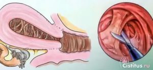Что такое синехии в полости матки в постменопаузе