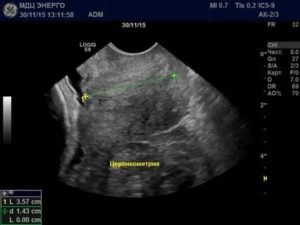 Узи шейки матки при многоплодной беременности
