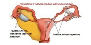 Сбор трав от спаек в маточных трубах