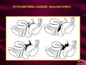 Ретроцервикальный эндометриоз это рак или нет