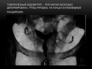 Диагностика туберкулеза маточных труб