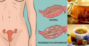 Что такое поликистоз яичников проходит после родов