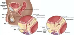 Боль в простате при семяиспускание у мужчин причины