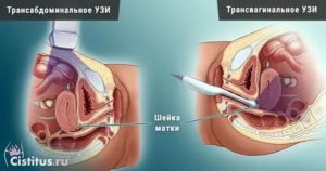 Чем вагинальное узи отличается от трансабдоминального
