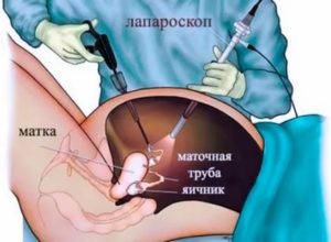 Эко после лапароскопии эндометриоза когда можно