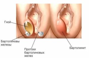 Может ли сама рассосаться киста бартолиновой железы