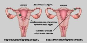 Могут ли идти месячные во время беременности если матка двурогая
