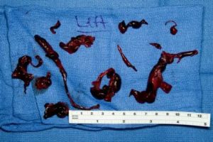 Что делать если нет прокладок а месячные начались сильные