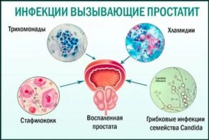 Грибковые заболевания предстательной железы