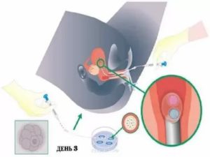 Вспомогательные репродуктивные технологии в лечении бесплодного брака