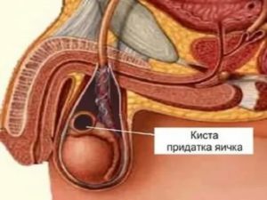 Злокачественная опухоль семенного канатика