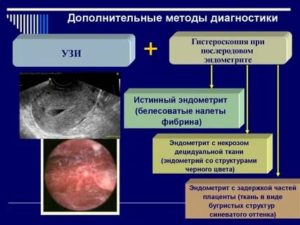 Эндомиометрит этиология клиника диагностика лечение