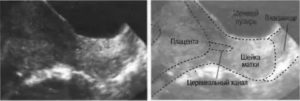 Узи матки плод прикреплен к задней стенке матки