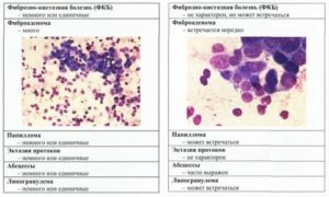 Чешуйки плоского эпителия в мазке на цитологию молочной железы