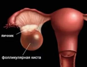 Какие признаки если есть киста на яичнике если она лопнула