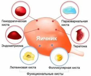 Можно ли при кисте яичника делать магнитотерапию