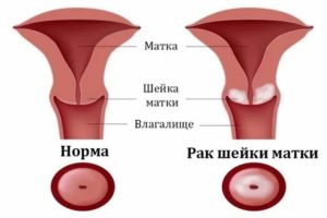 Рецидив рака матки после операции как проявляется