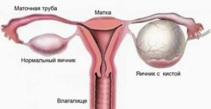 Можно ли рожать с кистой яичника кто рожал
